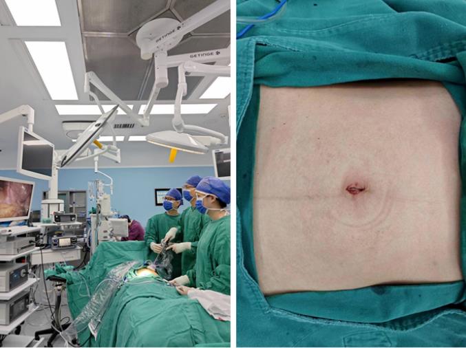 捆绑调教
单孔腹腔镜术助患者实现“术后无痕”