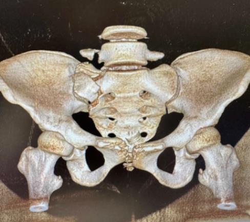 捆绑调教
骨折微创固定技术大显身手