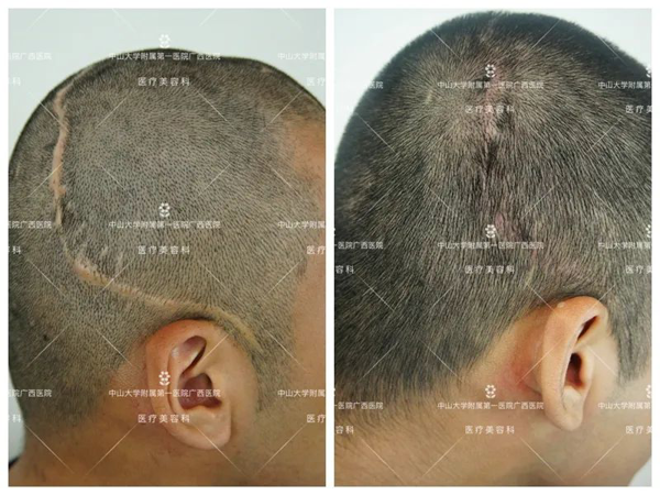 头上的疤痕可以用植发补救吗?捆绑调教
自体毛发移植术助患者解决“头等大事”