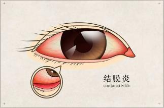 看一眼，就红眼？“红眼病”进入流行季，这份预防指南请收好