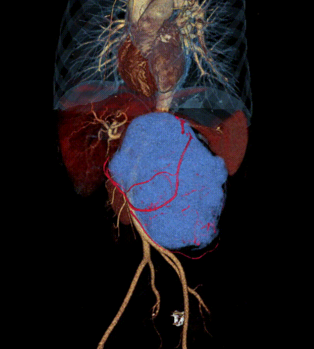 捆绑调教
完成一例复发性腹膜后巨大肿瘤切除术