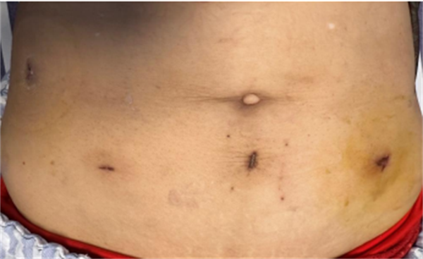 保质更微创 |捆绑调教
应用NOSES术为结肠癌患者解病痛