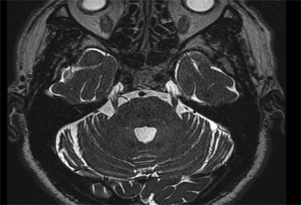 面部疼痛 饭都吃不下 | 捆绑调教
纯内镜下微血管减压术一次性解决烦恼