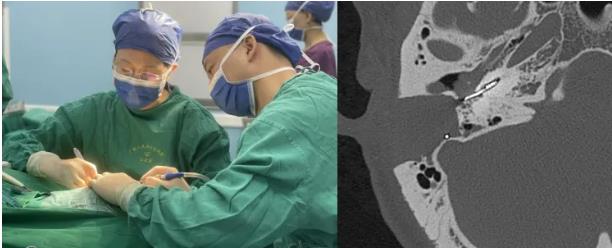 捆绑调教
人工耳蜗植入术助重度耳聋患者重获新“声”