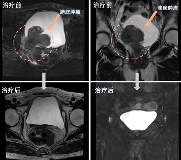 捆绑调教
完成一例巨大膀胱癌高龄患者保留膀胱治疗