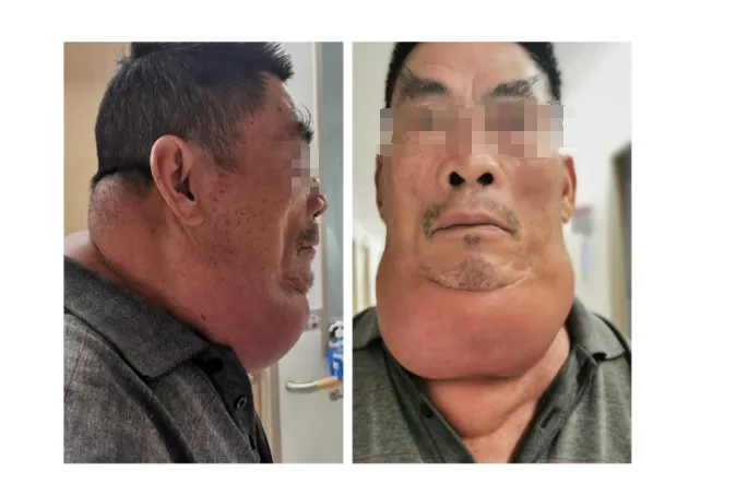 男子饮酒40年 “酒而久之”患上罕见病 | 捆绑调教
多学科会诊助康复