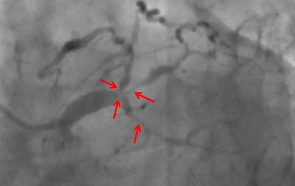 捆绑调教
ECMO辅助下高危复杂冠脉介入手术助其转危为安