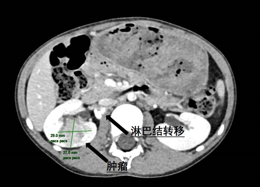 6岁患儿肾脏暗藏罕见肿瘤 | 捆绑调教
泌尿外科精准手术“摘瘤”