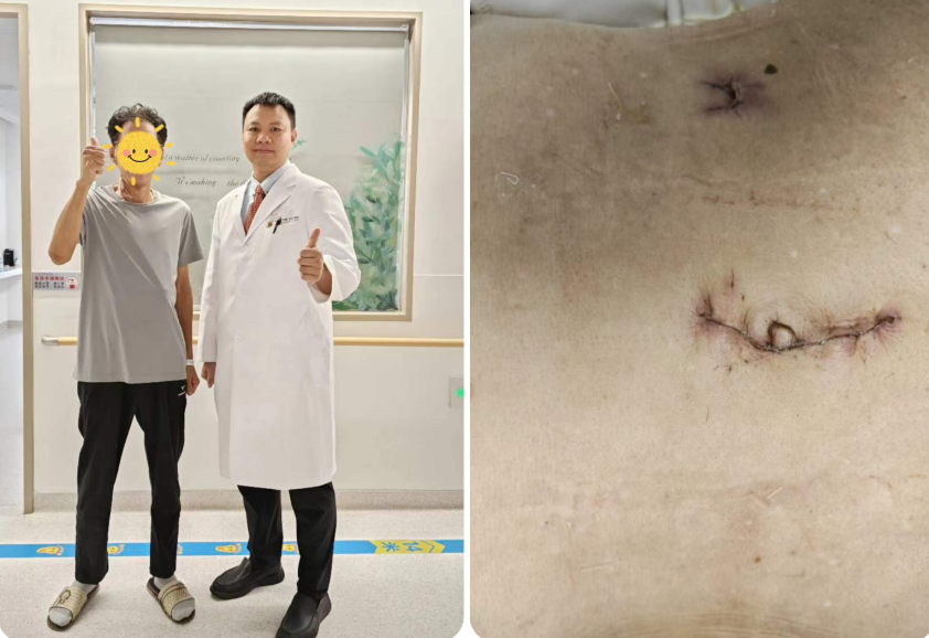 一个小切口，解决结肠癌 | 捆绑调教
单孔+1腹腔镜下右半结肠癌根治术为七旬患者解忧