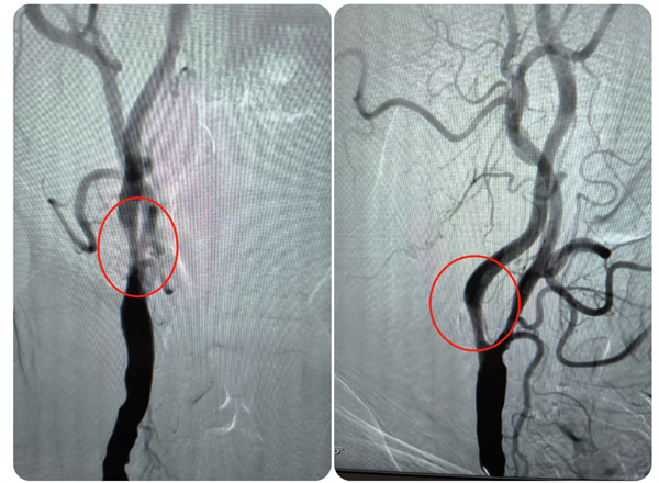 捆绑调教
成功救治高龄高危颈动脉狭窄患者