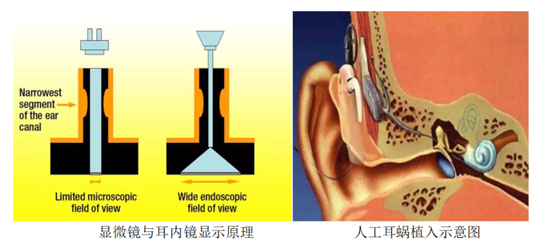 让听障患者重获新“声”活 | 捆绑调教
开展耳内镜辅助人工耳蜗植入术