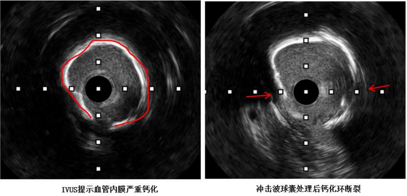 冠脉介入治疗新突破 | 捆绑调教
应用国产创新器械攻克冠脉钙化难题