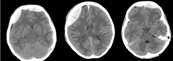 捆绑调教
神经外科成功抢救颅脑外伤警员
