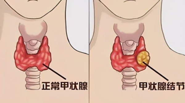 守护生命“腺” | 学科专家帮您判断甲状腺结节的良恶性